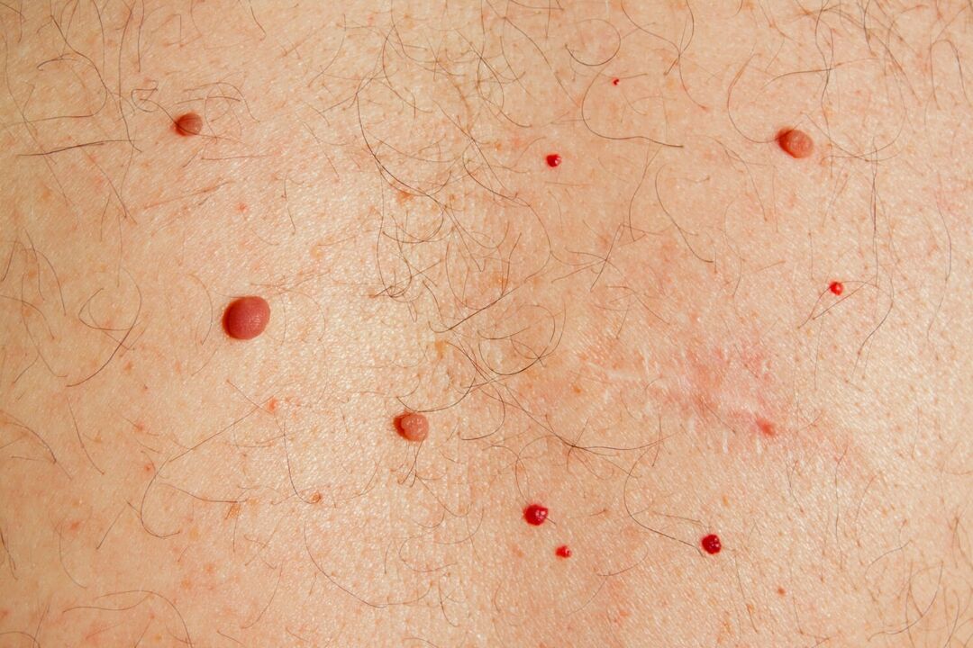 Papiloame pe corp cauzate de HPV