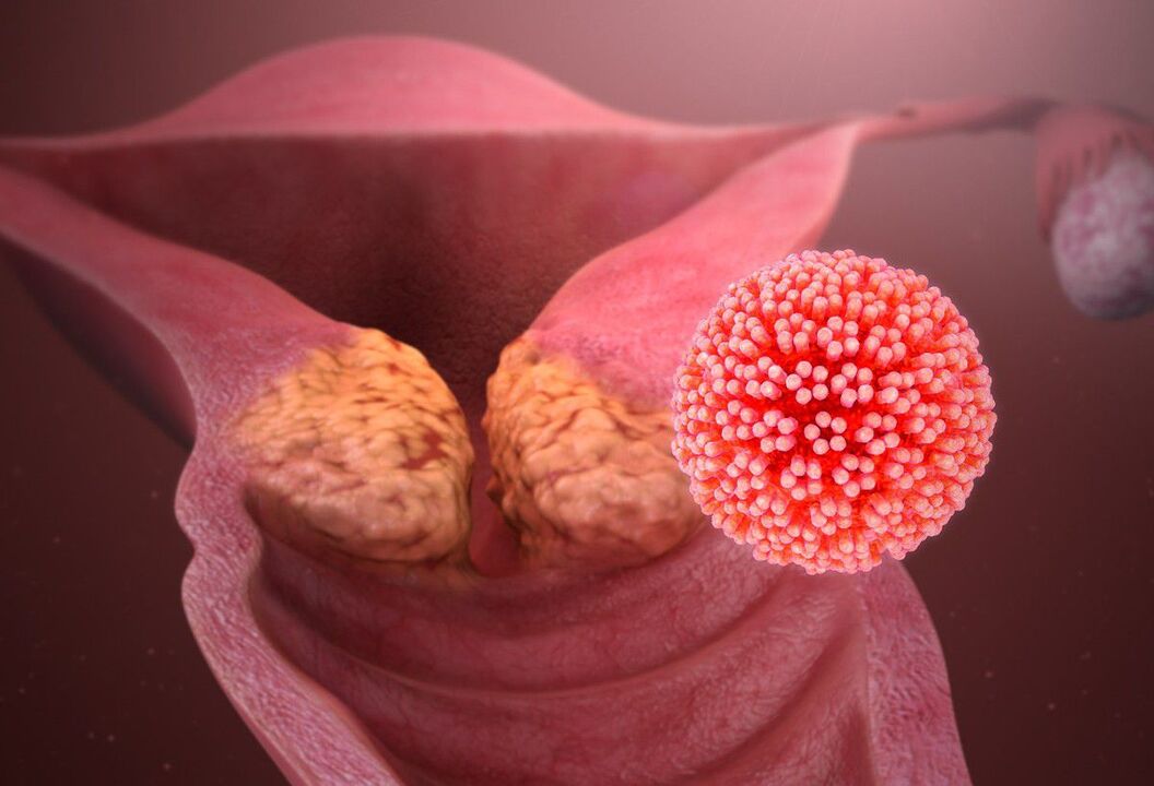 Leziunea HPV a colului uterin