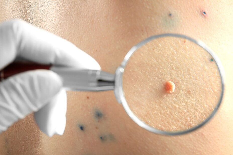 Papiloame plate pe corp. HPV genotipare în leziune/raclat (regiunea anogenitală și orală)